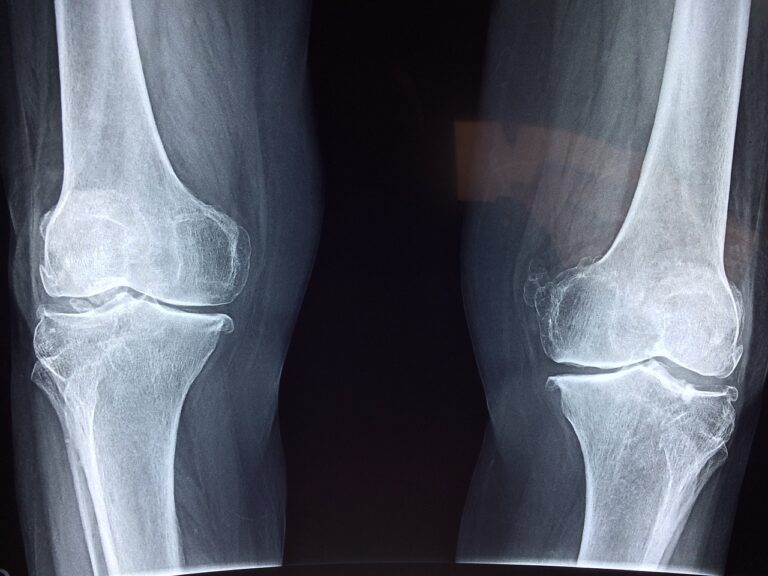 Reclaim Your Life with Joint Replacement